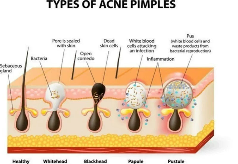 10-100pcs Nose Blackhead Remover Mask Deep Cleansing Skin Ca