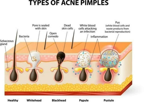 10-100pcs Nose Blackhead Remover Mask Deep Cleansing Skin Ca